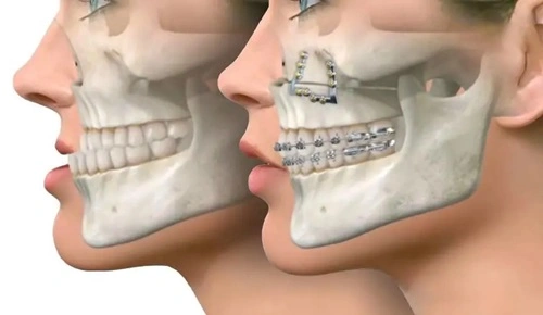 Jaw Surgery