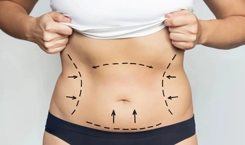 Liposuction Surgery