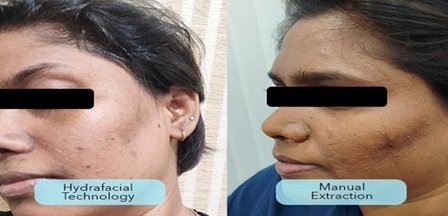 Gentle Yet Effective