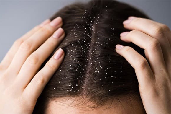 dandruff