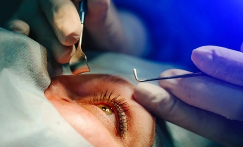  Cataract Surgery Enhances Quality of Life